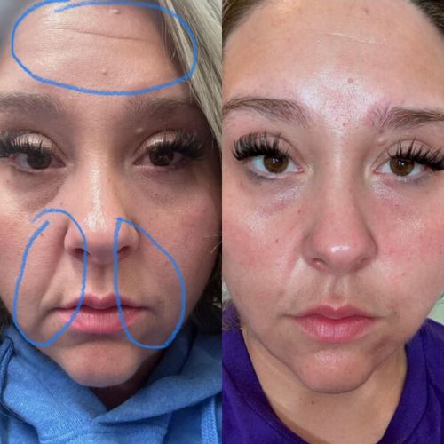 Facial Patches for Wrinkles on the Corner of Eyes & Mouth