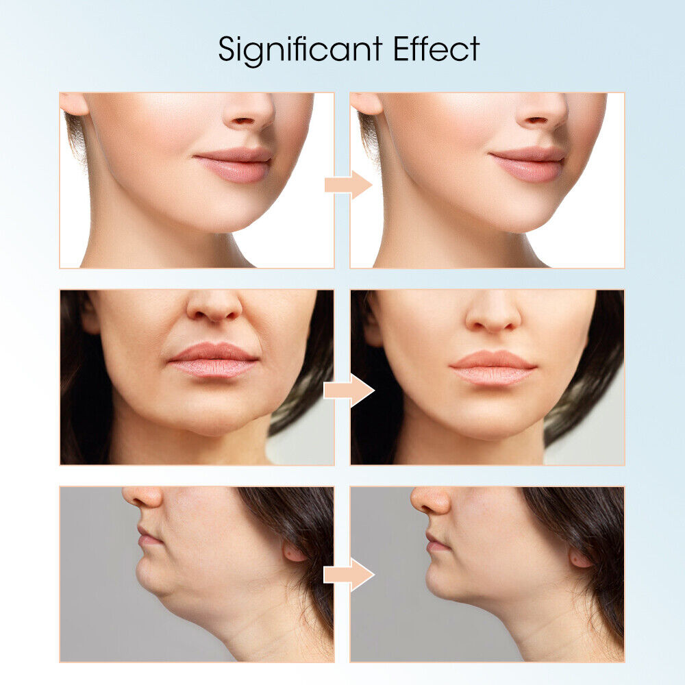 Smart V-Lift Facial Contouring Device